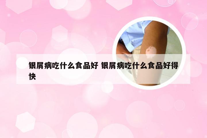银屑病吃什么食品好 银屑病吃什么食品好得快