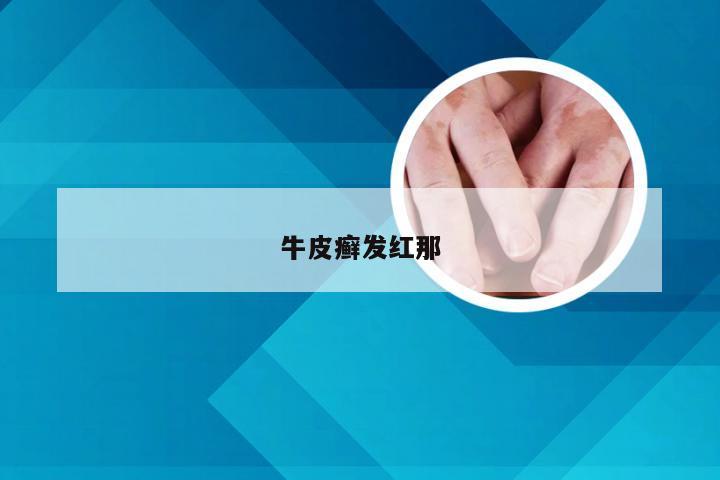 牛皮癣发红那