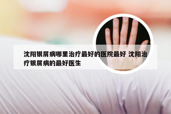 沈阳银屑病哪里治疗最好的医院最好 沈阳治疗银屑病的最好医生