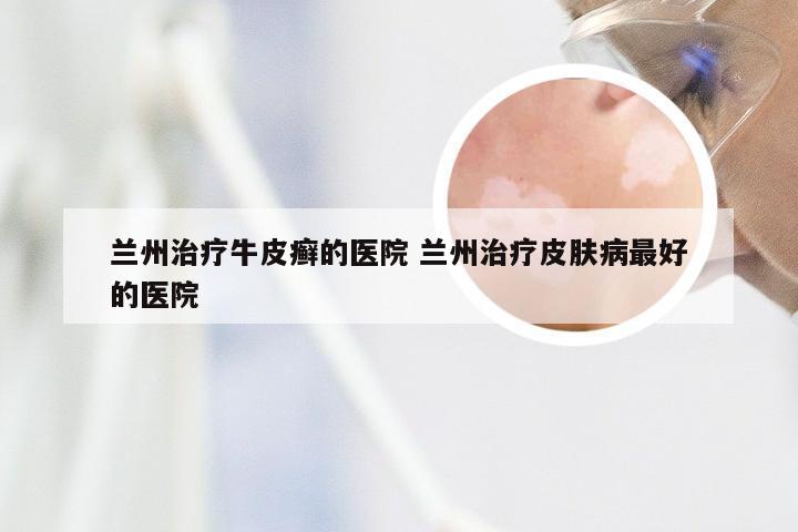 兰州治疗牛皮癣的医院 兰州治疗皮肤病最好的医院