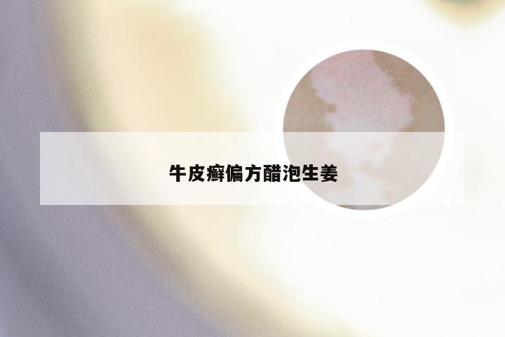 牛皮癣偏方醋泡生姜