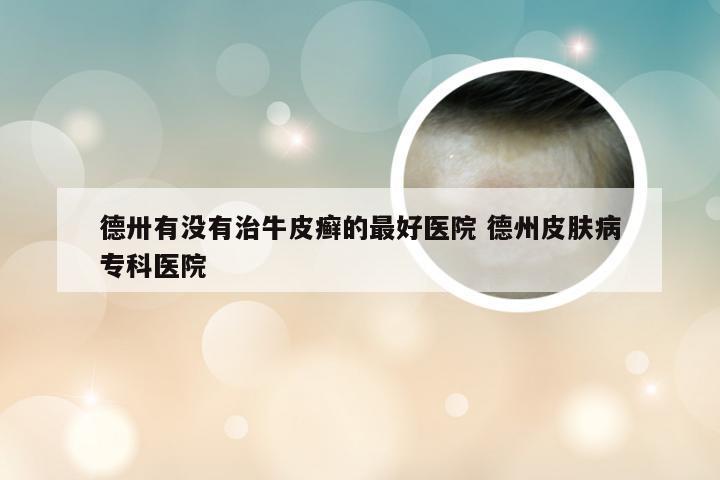 德卅有没有治牛皮癣的最好医院 德州皮肤病专科医院