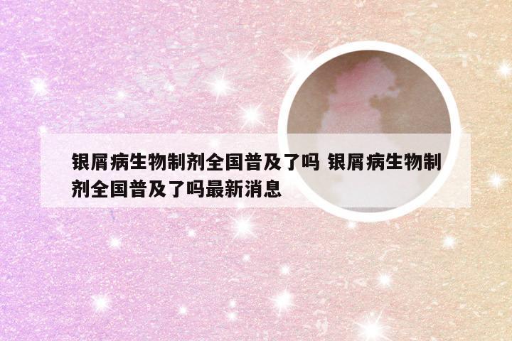 银屑病生物制剂全国普及了吗 银屑病生物制剂全国普及了吗最新消息