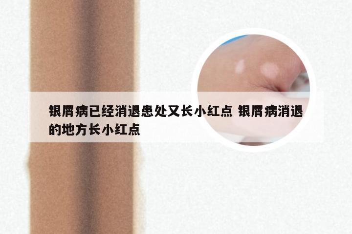 银屑病已经消退患处又长小红点 银屑病消退的地方长小红点