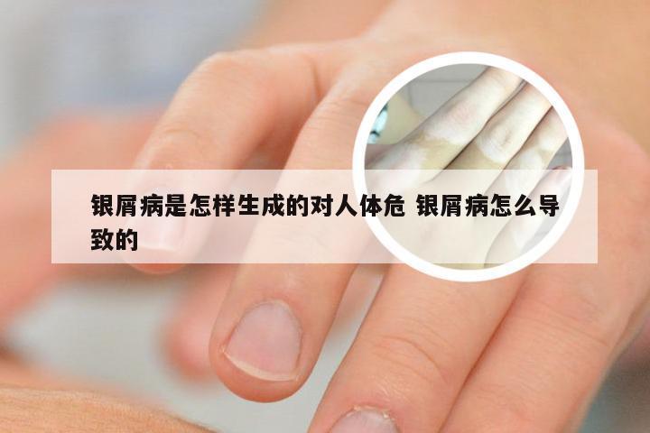 银屑病是怎样生成的对人体危 银屑病怎么导致的