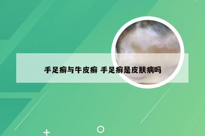 手足癣与牛皮癣 手足癣是皮肤病吗
