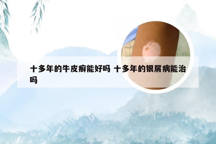 十多年的牛皮癣能好吗 十多年的银屑病能治吗