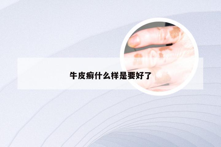 牛皮癣什么样是要好了