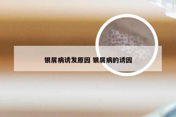 银屑病诱发原因 银屑病的诱因