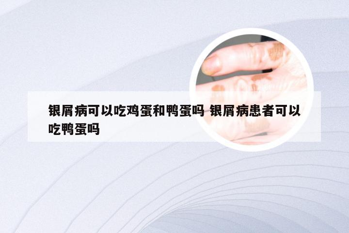 银屑病可以吃鸡蛋和鸭蛋吗 银屑病患者可以吃鸭蛋吗