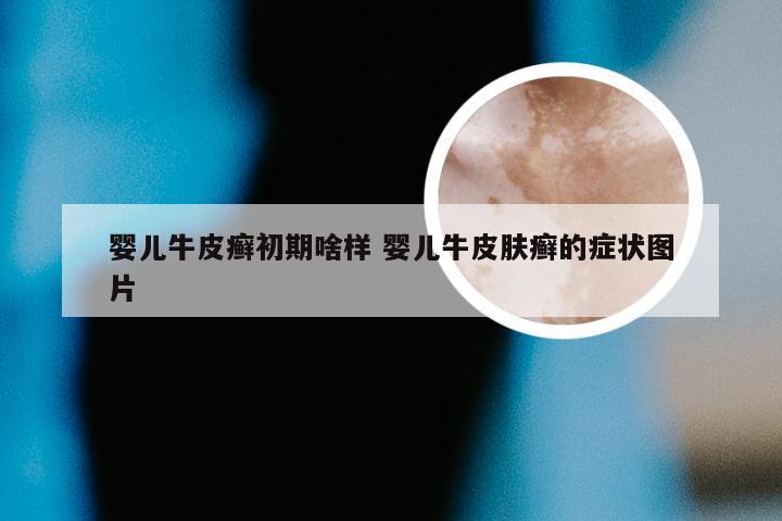 婴儿牛皮癣初期啥样 婴儿牛皮肤癣的症状图片