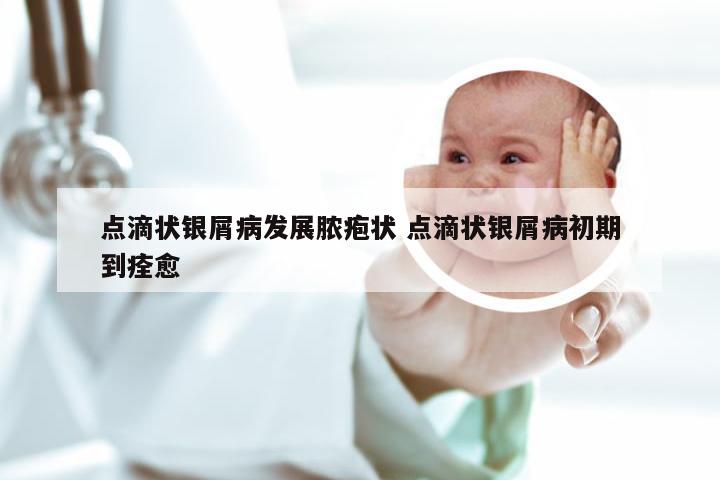 点滴状银屑病发展脓疱状 点滴状银屑病初期到痊愈