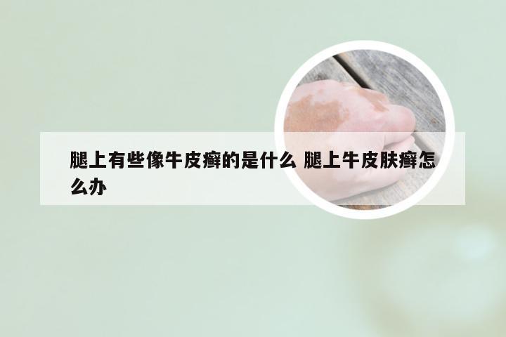 腿上有些像牛皮癣的是什么 腿上牛皮肤癣怎么办