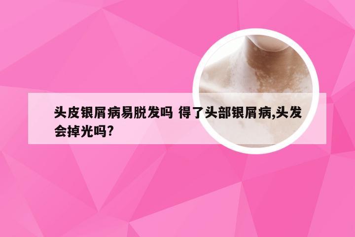 头皮银屑病易脱发吗 得了头部银屑病,头发会掉光吗?
