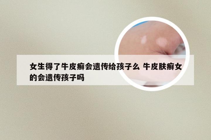 女生得了牛皮癣会遗传给孩子么 牛皮肤癣女的会遗传孩子吗