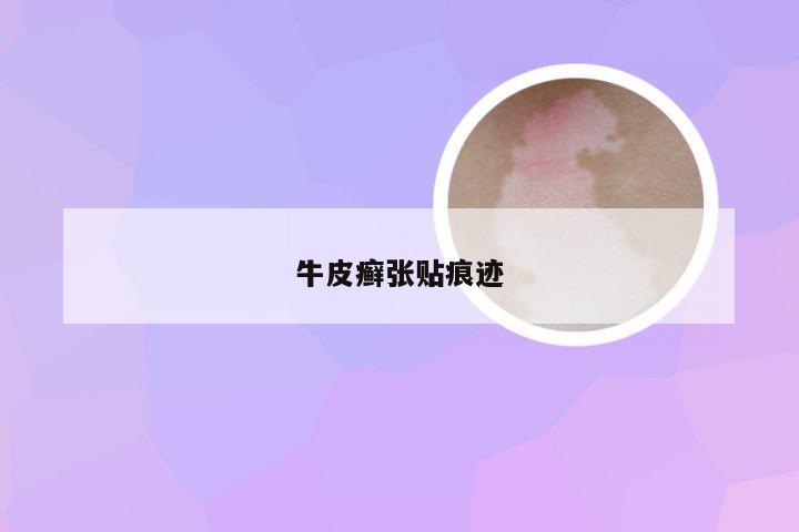 牛皮癣张贴痕迹