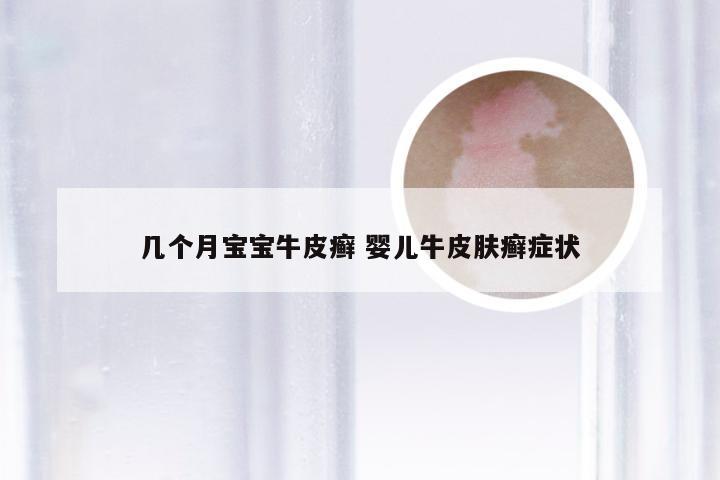 几个月宝宝牛皮癣 婴儿牛皮肤癣症状