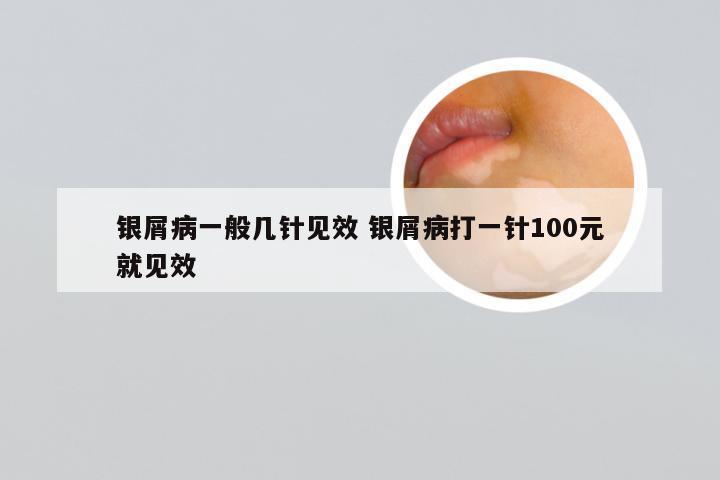 银屑病一般几针见效 银屑病打一针100元就见效