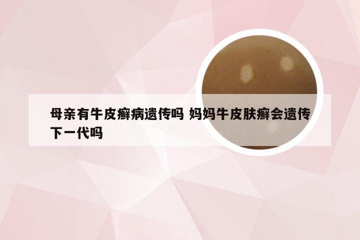 母亲有牛皮癣病遗传吗 妈妈牛皮肤癣会遗传下一代吗