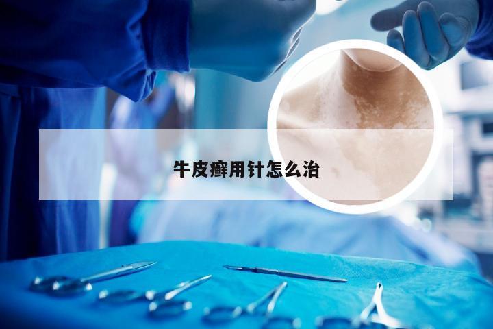 牛皮癣用针怎么治