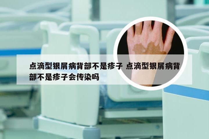 点滴型银屑病背部不是疹子 点滴型银屑病背部不是疹子会传染吗