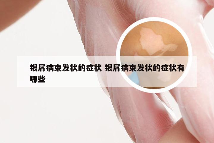银屑病束发状的症状 银屑病束发状的症状有哪些