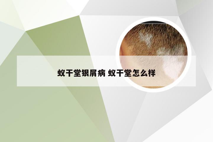 蚁干堂银屑病 蚁干堂怎么样