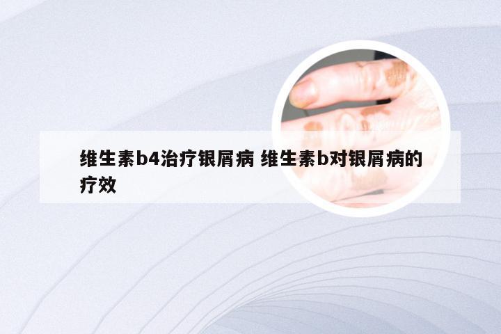 维生素b4治疗银屑病 维生素b对银屑病的疗效