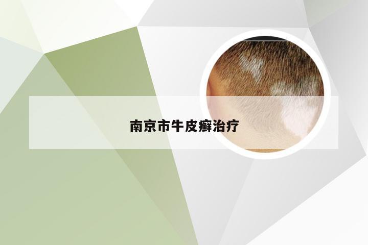 南京市牛皮癣治疗