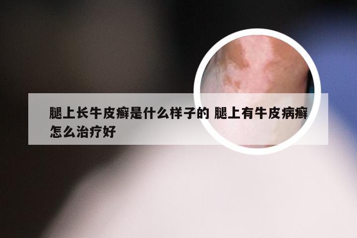 腿上长牛皮癣是什么样子的 腿上有牛皮病癣怎么治疗好