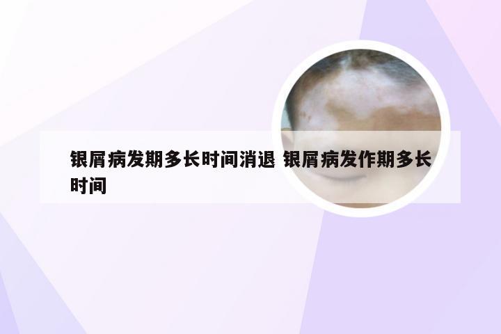 银屑病发期多长时间消退 银屑病发作期多长时间