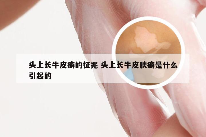 头上长牛皮癣的征兆 头上长牛皮肤癣是什么引起的