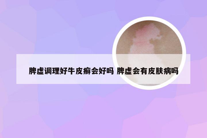 脾虚调理好牛皮癣会好吗 脾虚会有皮肤病吗
