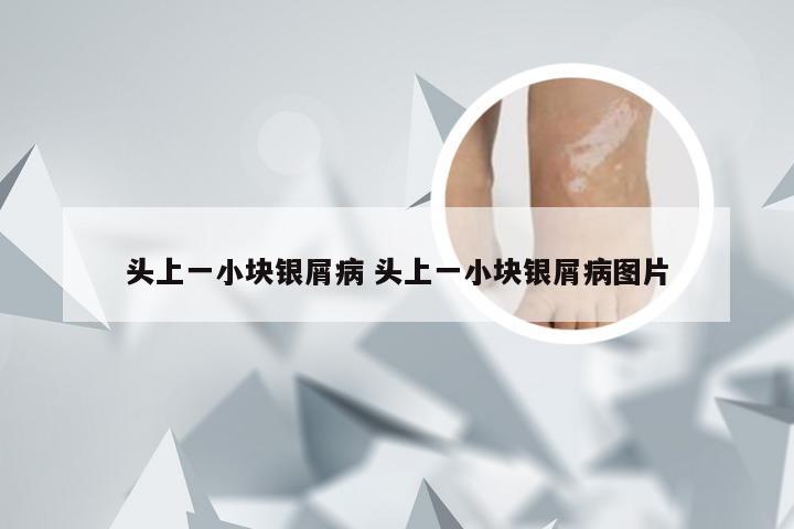 头上一小块银屑病 头上一小块银屑病图片