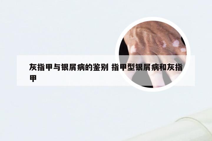 灰指甲与银屑病的鉴别 指甲型银屑病和灰指甲