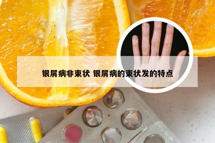 银屑病非束状 银屑病的束状发的特点