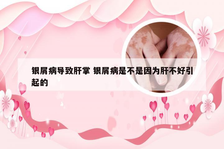 银屑病导致肝掌 银屑病是不是因为肝不好引起的