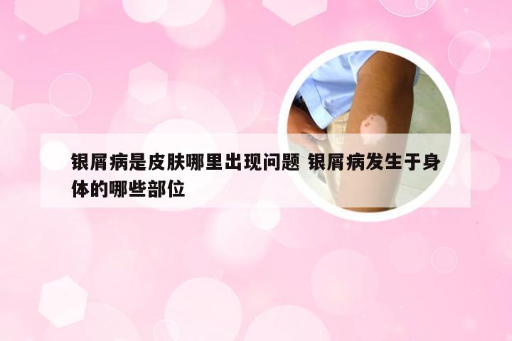 银屑病是皮肤哪里出现问题 银屑病发生于身体的哪些部位