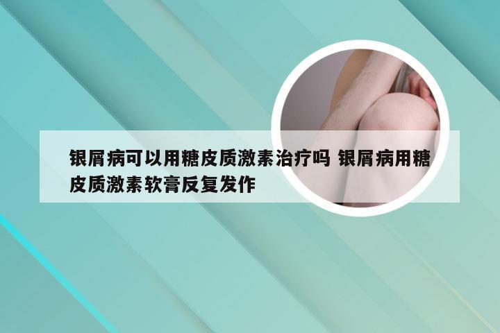 银屑病可以用糖皮质激素治疗吗 银屑病用糖皮质激素软膏反复发作