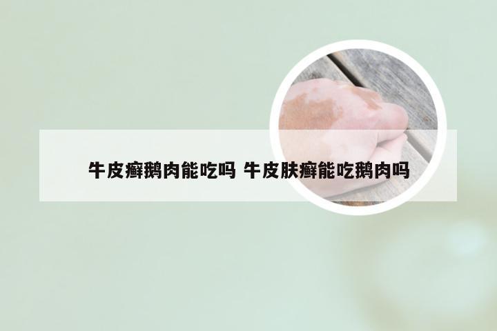 牛皮癣鹅肉能吃吗 牛皮肤癣能吃鹅肉吗