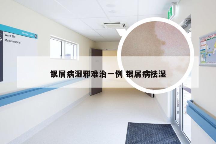 银屑病湿邪难治一例 银屑病祛湿
