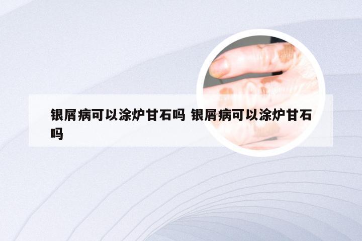 银屑病可以涂炉甘石吗 银屑病可以涂炉甘石吗