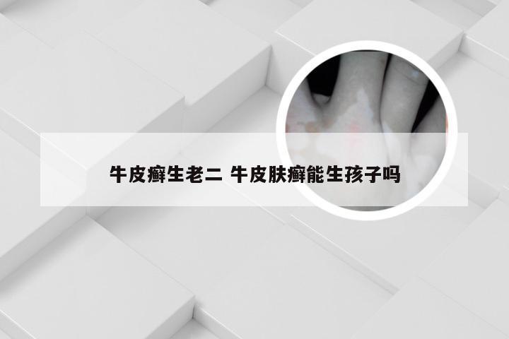 牛皮癣生老二 牛皮肤癣能生孩子吗