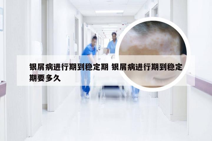 银屑病进行期到稳定期 银屑病进行期到稳定期要多久