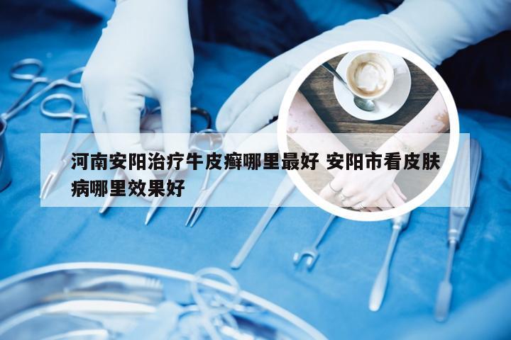 河南安阳治疗牛皮癣哪里最好 安阳市看皮肤病哪里效果好