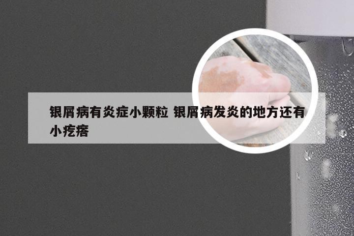 银屑病有炎症小颗粒 银屑病发炎的地方还有小疙瘩