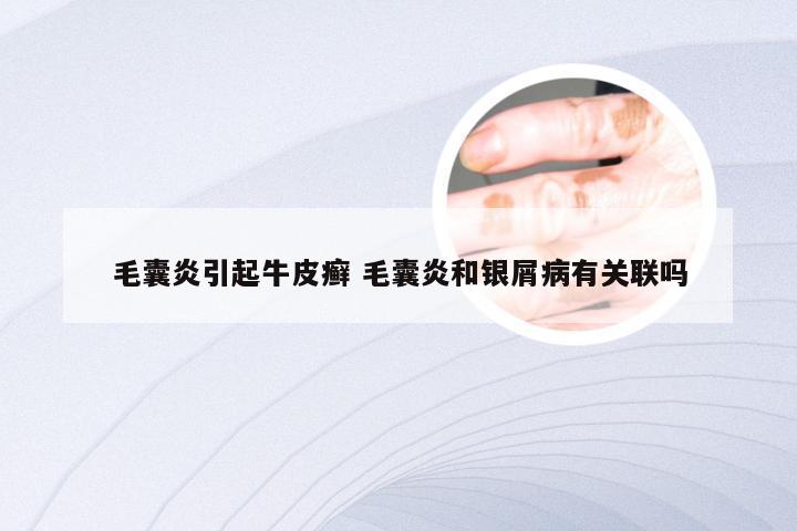 毛囊炎引起牛皮癣 毛囊炎和银屑病有关联吗