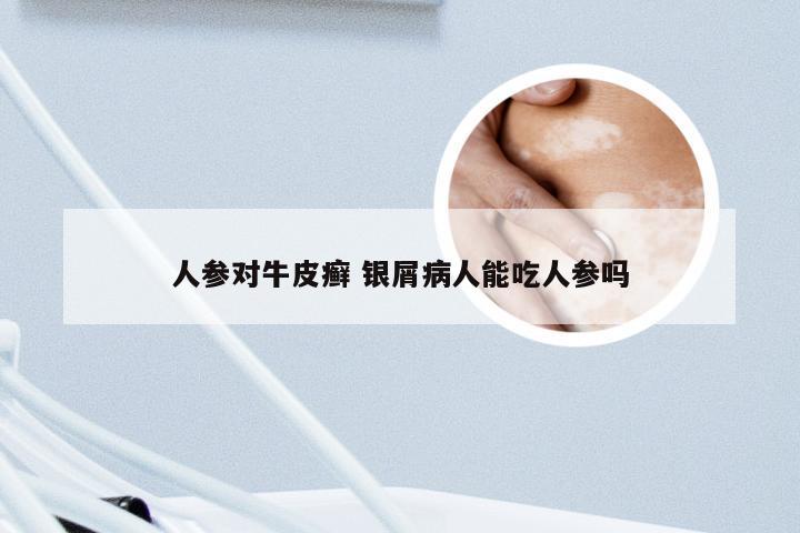 人参对牛皮癣 银屑病人能吃人参吗