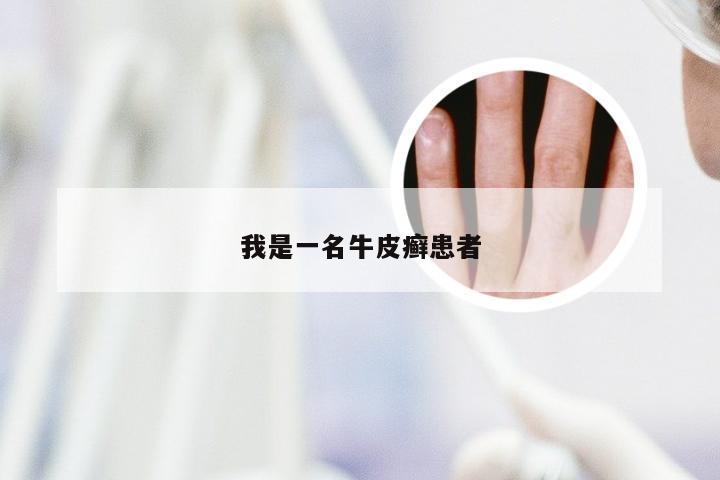 我是一名牛皮癣患者