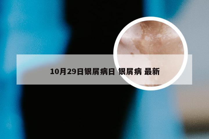 10月29日银屑病日 银屑病 最新